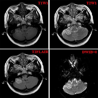 Case report: Rare case of multinodular and vacuolar neuronal tumors in the cerebellum